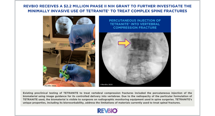 RevBio Wins NIH Grant to Develop Minimally Invasive Spine Fracture Treatment